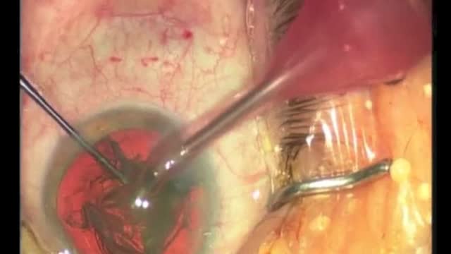 Evolving Techniques in Femtosecond Laser Cataract Surgery