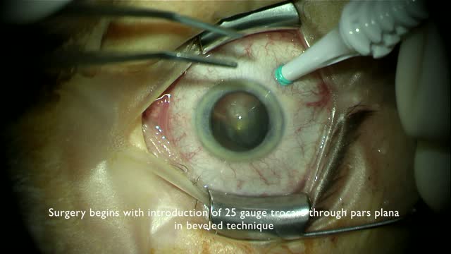 Essential Steps in Retinal Detachment Repair Using 25G Vitrectomy
