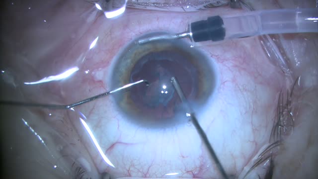 Cataract Surgery Using Vitreous Cutter Without Phacoemulsification