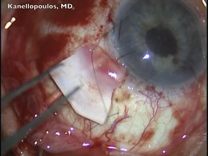 Retropupilary Artisan IOL and Ahmed Valve Implantation in Axenfeld-Rieger Patient