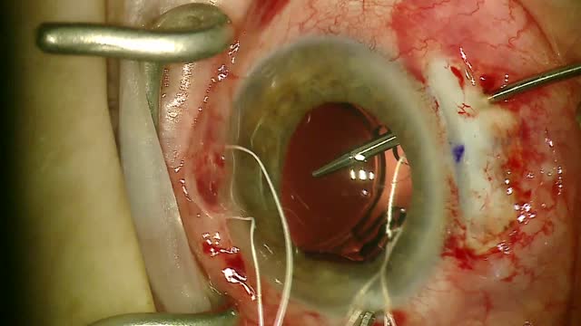 Novel Approach to a Gore-Tex Fixated IOL With Use of Pediatric Bowman Probe