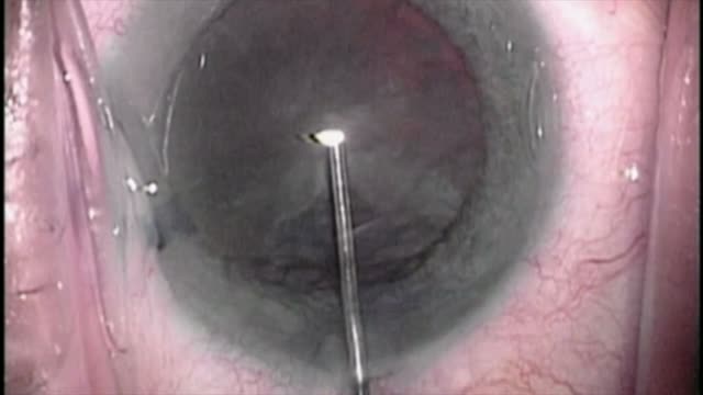 Brown Cataract Phaco Chop