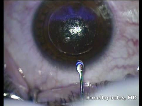 Small Lenticule Extraction