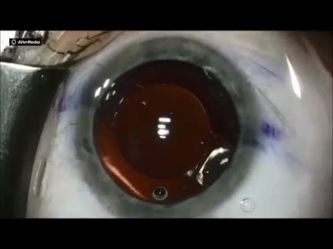 Trulign Insertion