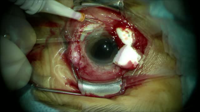 The Evolution of IOL Fixation Part II: Medium Incision 
