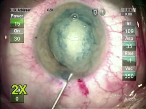 Ruptured Capsule Post PPV and Trabeculectomy