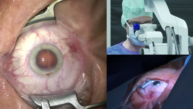 Dr. med Marc Schargus implants the Avansee Preset IOL