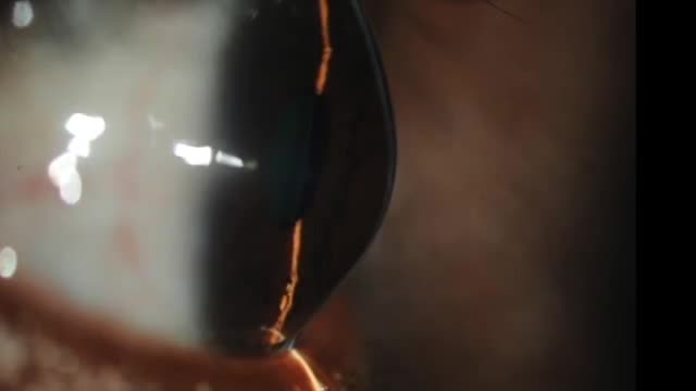 Grip and Rip ALK for Ectasia and Stromal Opacity: A Big Bubble Alternative