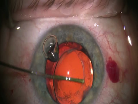 A Clinical Pearl for Posterior Capsular Haze