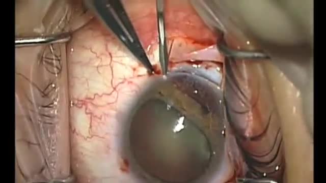 Iridodialysis, Capsular Bag Repair, Phacoemulsification and Intraocular Lens Insertion