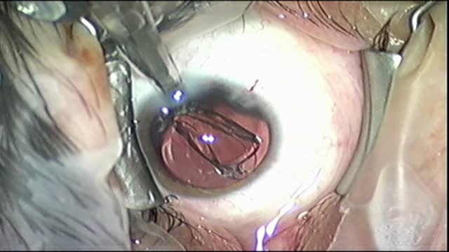 Posterior Polar Cataract