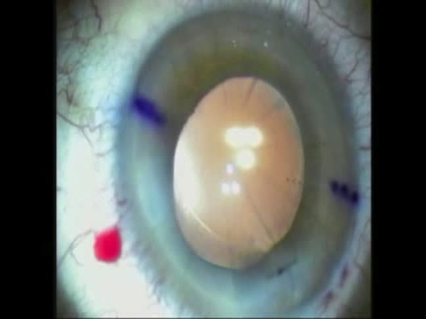 RK Suture in Patiet with Fuch' s and Dense Cataract