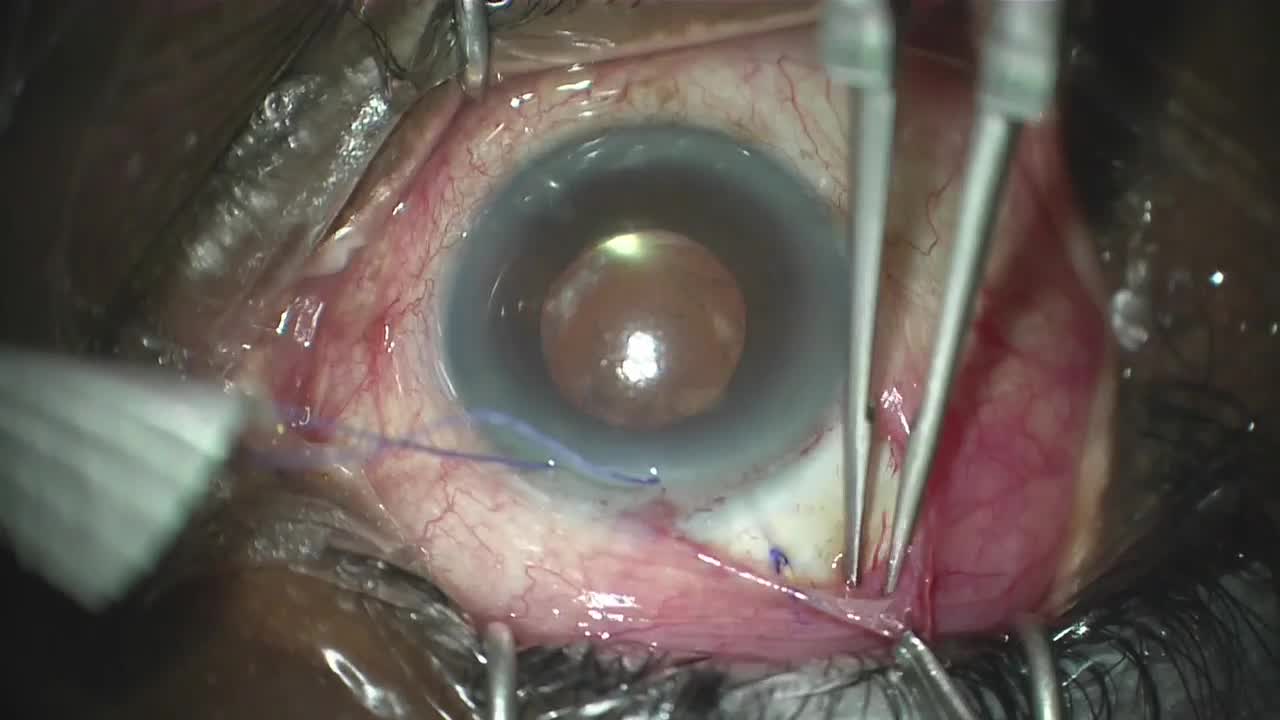 27-Gauge needle XEN implantation