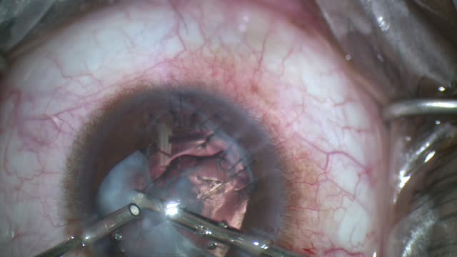 Lensectomy, Sutureless Intrascleral Fixation of IOL with Anterior Vitrectomy in a Child
