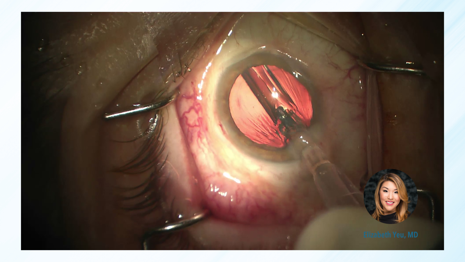 Implantation Pearls and Case Videos (9:21)