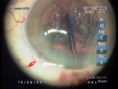 Posterior Capsulorhexis for Asteroid Hyalosis