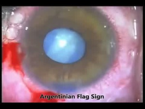 Capsulorhexis in Silicone–Oil-Filled Eye