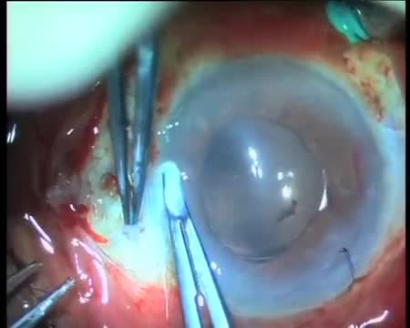 Live Glued IOL Surgery