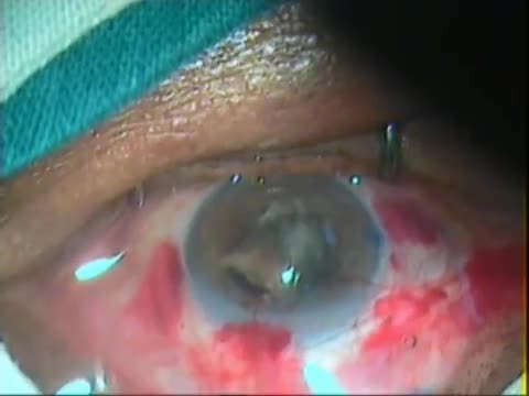 MSICS in Pseudoexfoliation and Non-dilating Pupil
