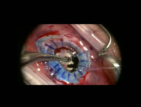 Sky's the Limit: Penetrating Lensectomy