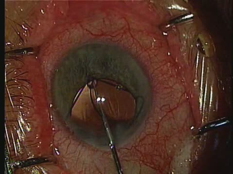 Malyugin Ring Insertion and Removal (Two Cases)