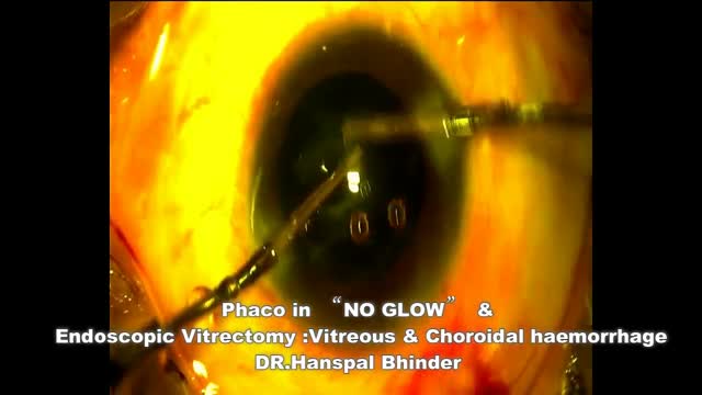 Phaco in NO GLOW + Endoscopic Vitrectomy in Vitreous & Choroidal Hemorrhage