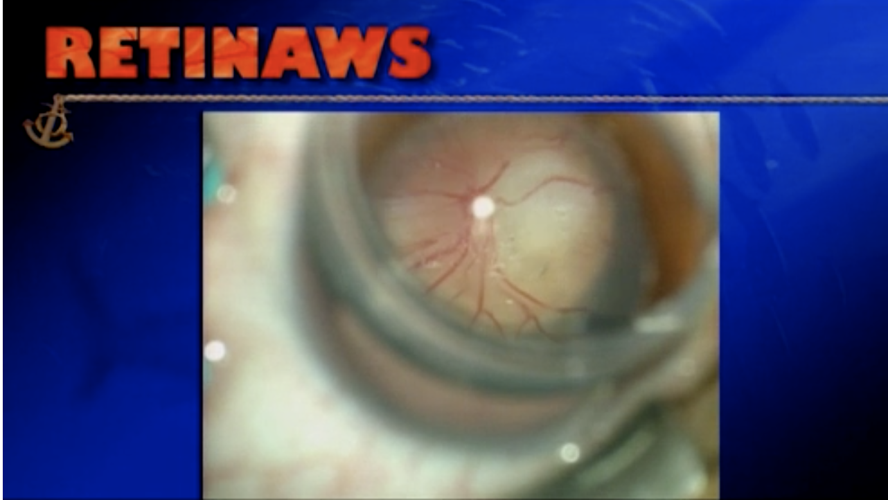 Peripapillary Staphyloma & RD