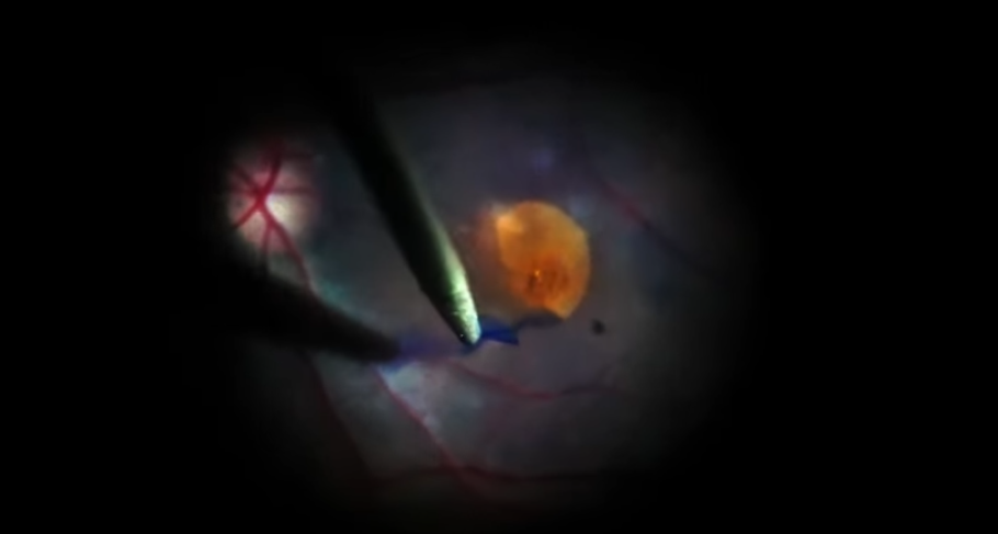 Early ILM Peel for Full-Thickness Macular Hole 