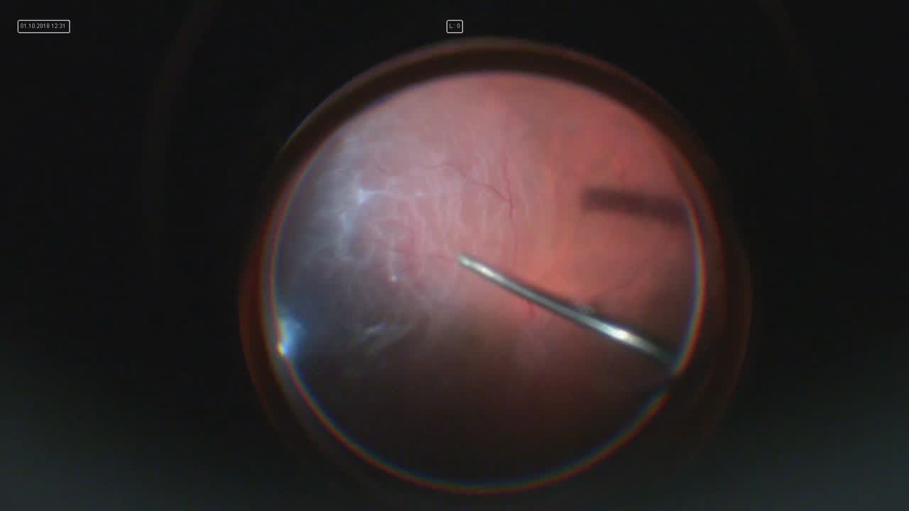 Posterior Vitreous Base and Zipper Syndrome Tears in Retinal Detachments