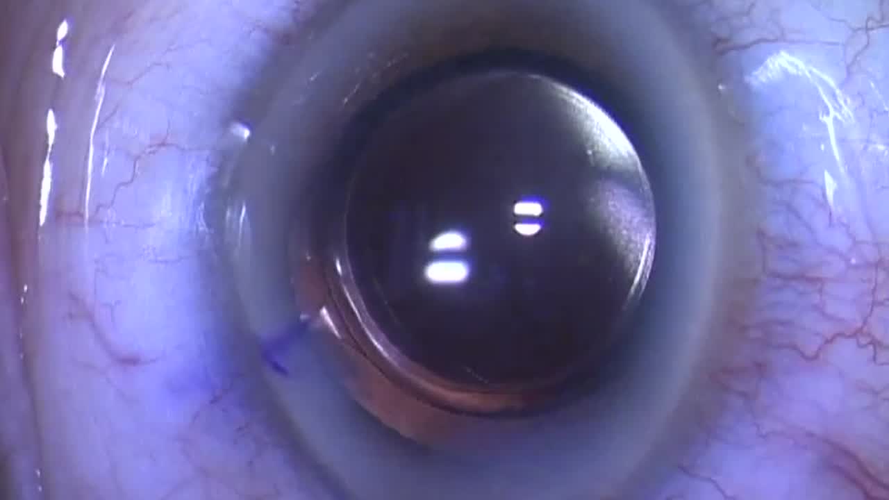 Dexycu Insertion With Quick Snap Technique