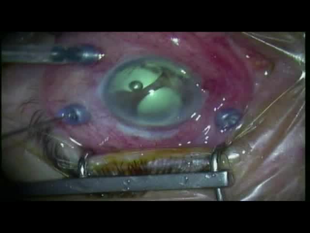 PPV & Pupilosplasty in Hemovitreous with Disturbed Anterior Segment