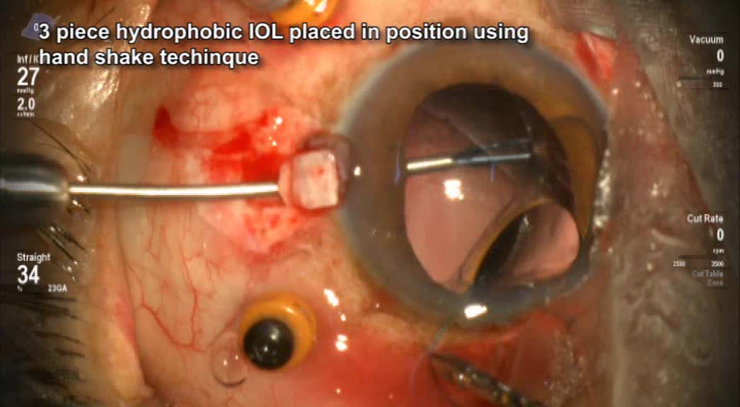 Glued IOL for Traumatic Dislocated Lens