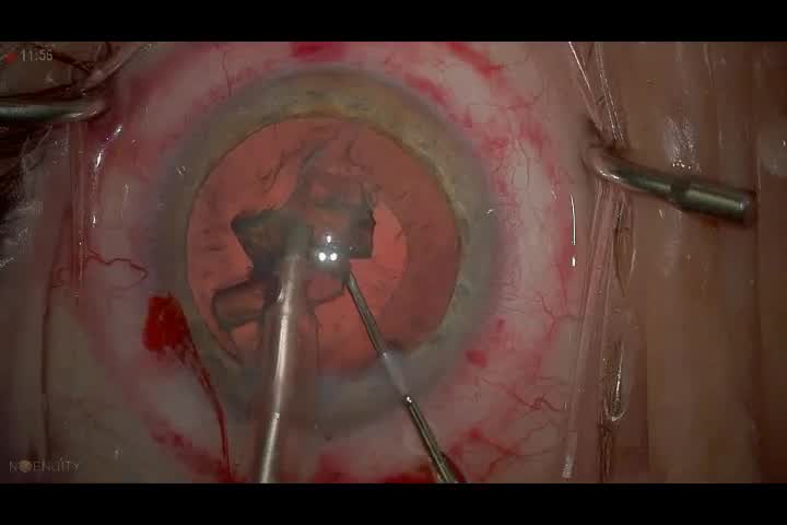 My Routine Cataract Surgery Case