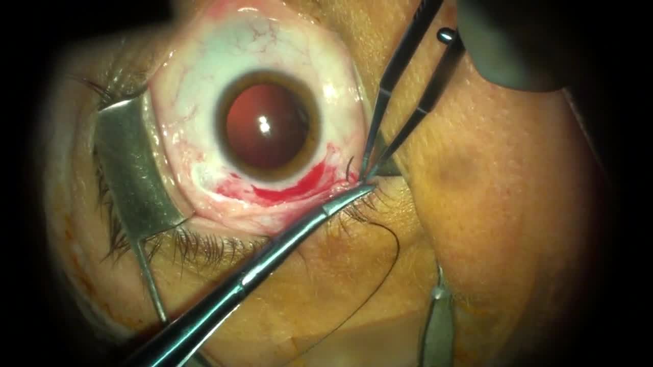 Lateral Rectus Recession With Half Stamp Rise and Inferior Oblique APT