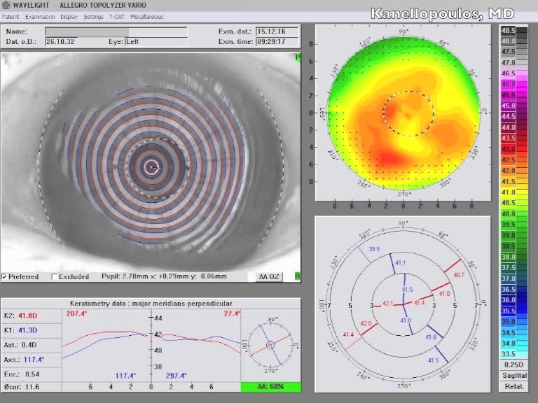 Sutureless Subluxated IBC Exchanged With RIC - Eyetube