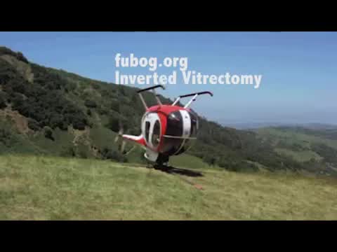 Posterior Retinotomy for Giant Retinal Tear With Fixed-Folds PVR