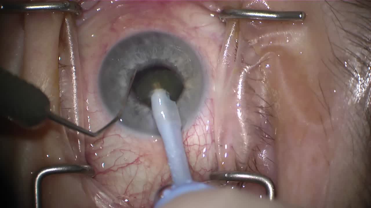 Small Pupil Phaco: How to Avoid Devices