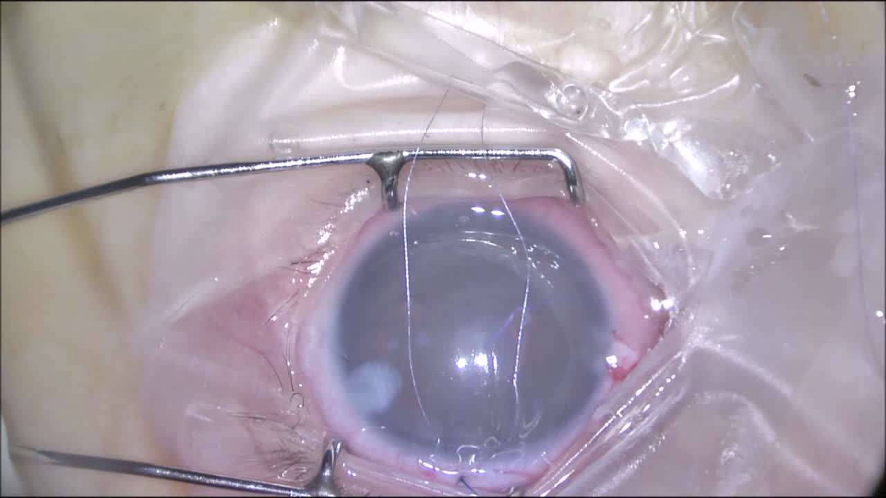 Pediatric Schlemm Canal Surgery: How to Deal With Challenges