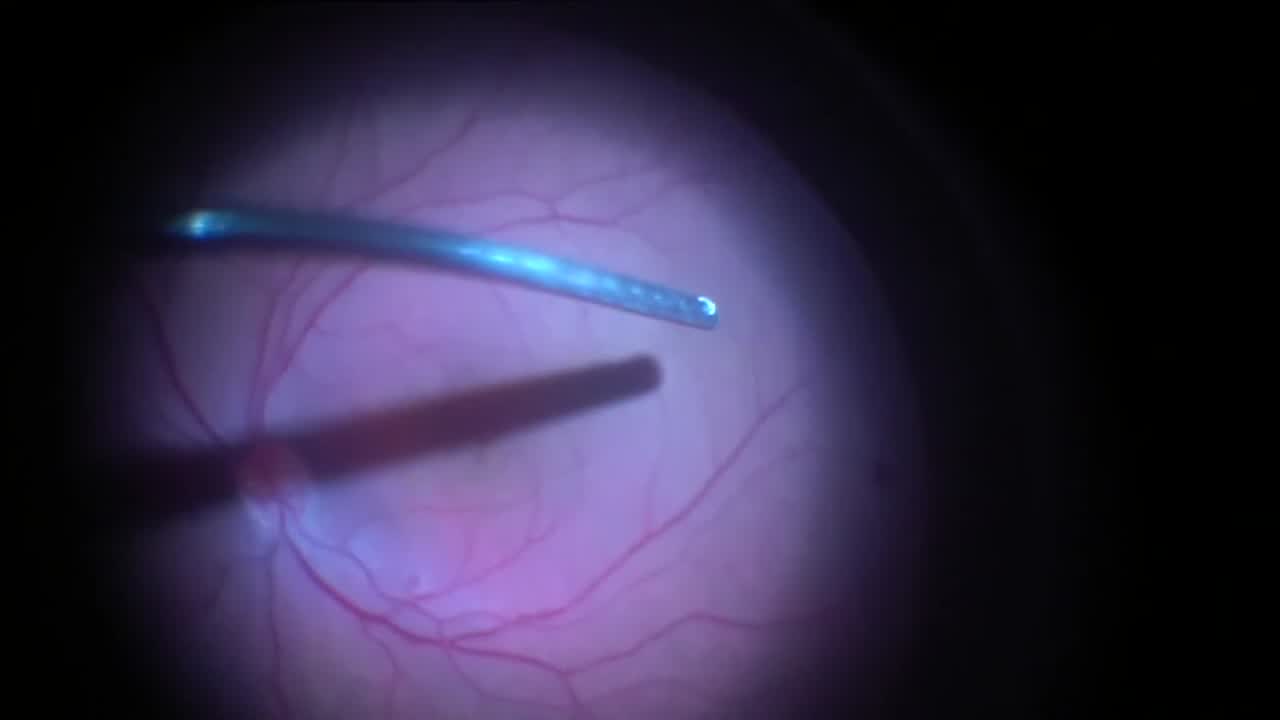 Vitrectomy for Traumatic Lens Dislocation With Perfluorocarbon Liquid and Fragmatome