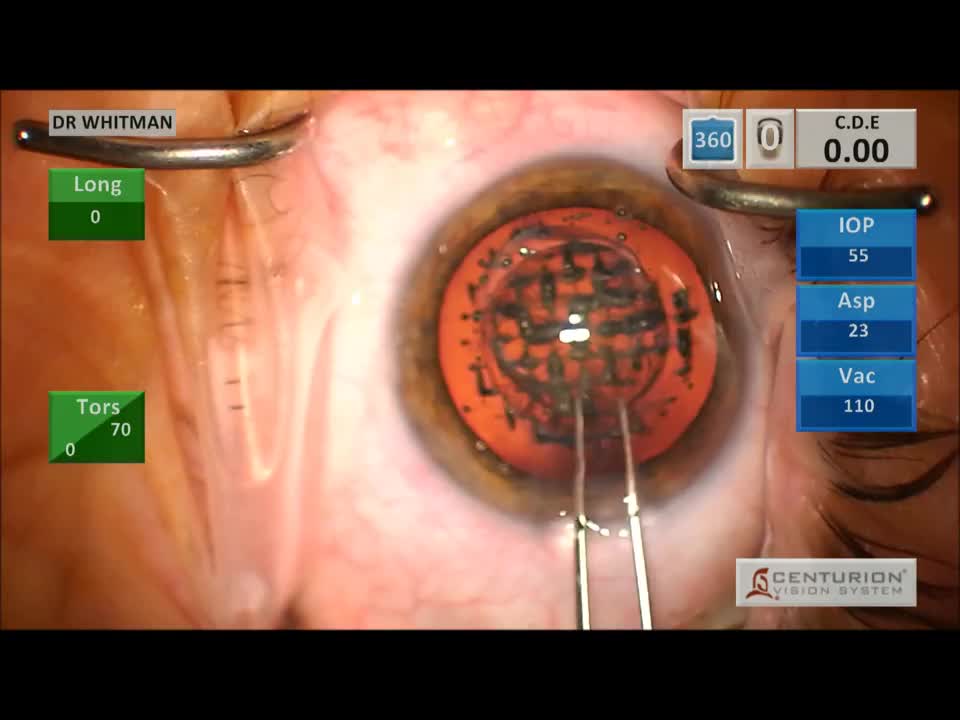 STAAR ICL Removal After Femtosecond Cataract Treatment Followed by Symfony Lens Insertion