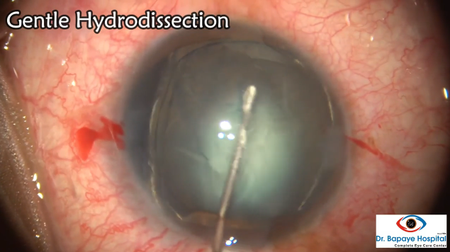 Phacoemulsification Hard Cataract With Lens Coloboma