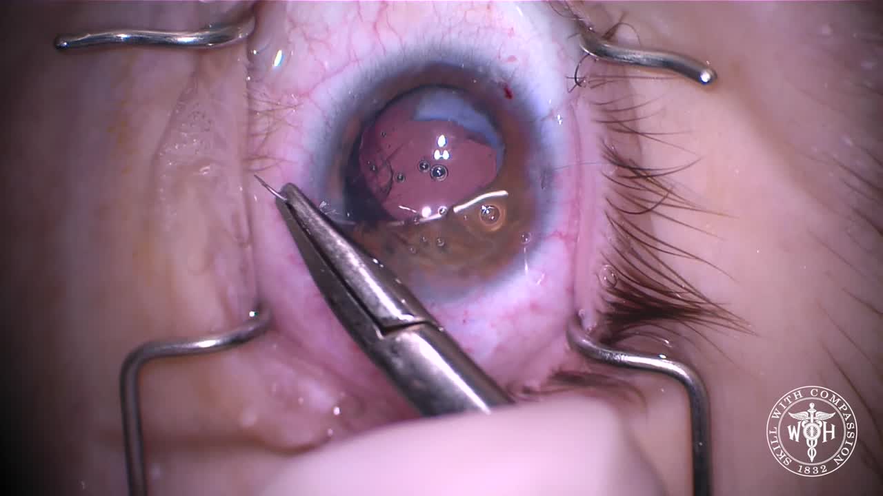 White Cataract Removal with Iris Repair