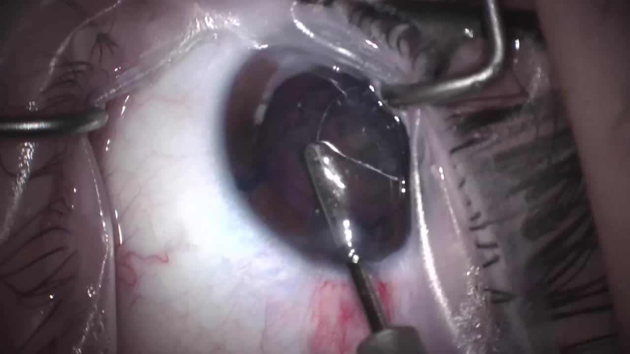 Traumatic Cataract with miLoop Advantages