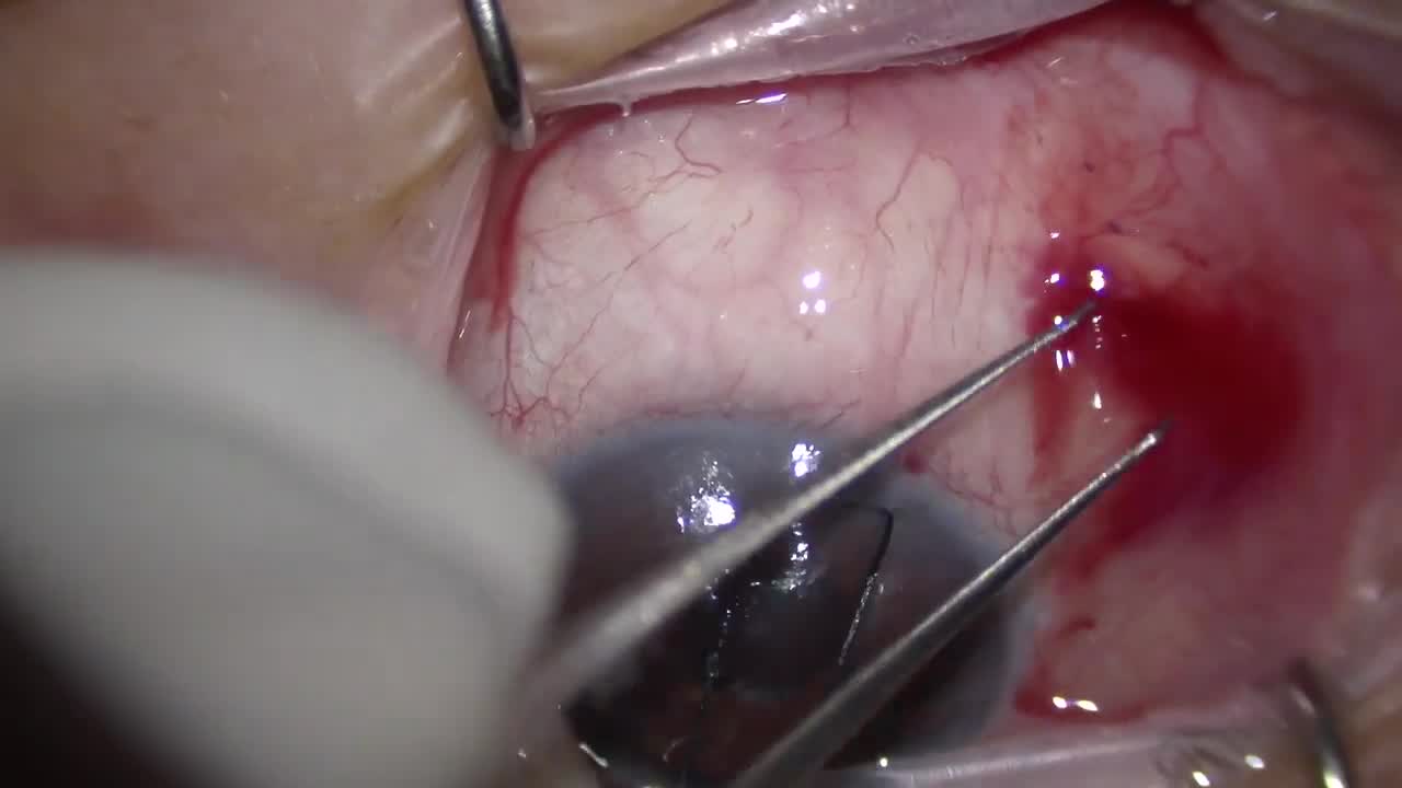 Ahmed ClearPath Placement Using Small Incision and Taco Technique