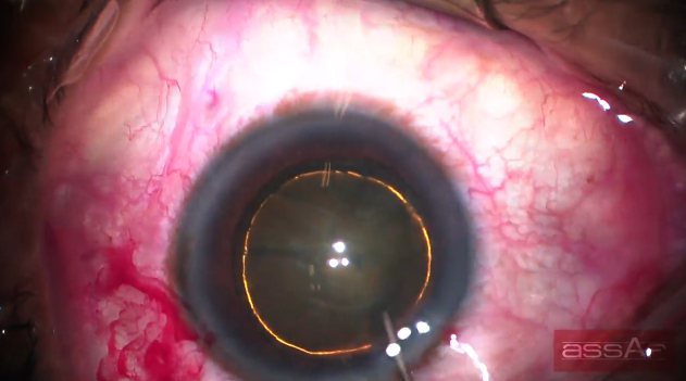 The Carousel Technique for Soft Cataracts