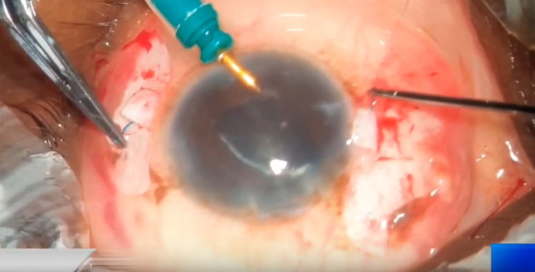 Glued IOL Scaffold Soemmering Ring Phacoemulsification 