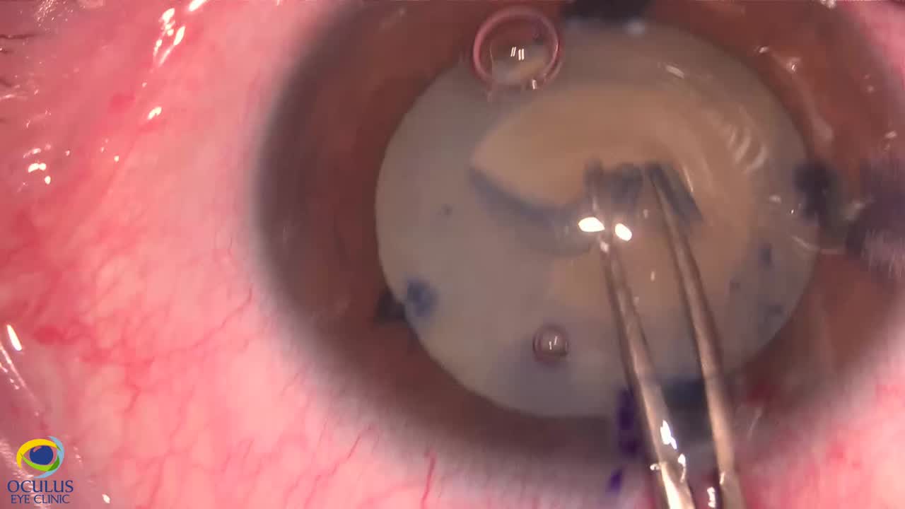 Phacoemulsification in Morgagnian Cataract