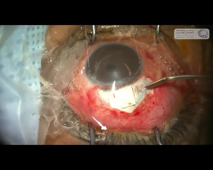 Deep Sclerectomy With Space Maintainer Implant 