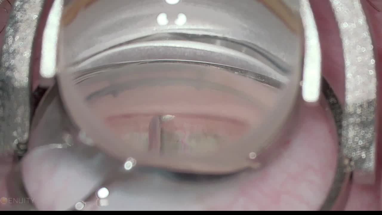 The Omni Surgical System Following Cataract Surgery