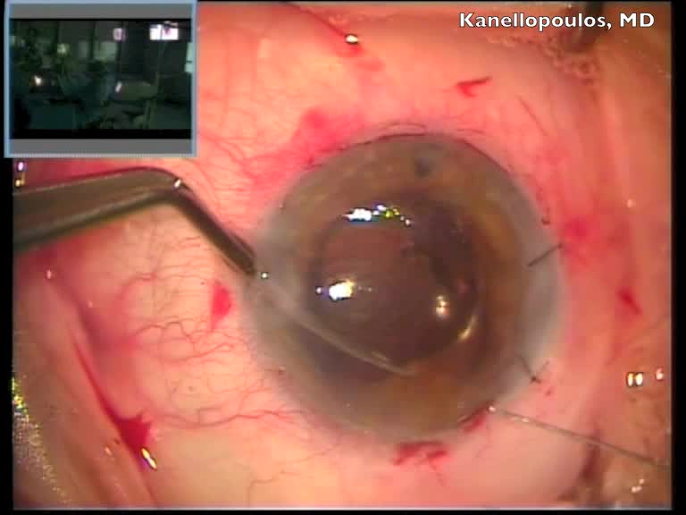 Bullous Keratopathy IOL Exchange and DSAEK Procedure With Challenging Iridoplasty